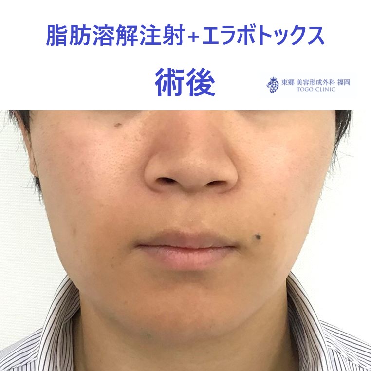 24コガヨシタカ　エラボトＢＮＬＳ術後_R