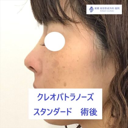 192フルヤタカコKPノーズ術後よこ_R