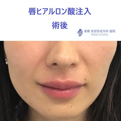 20レティシアミヤノハラ唇HA術後