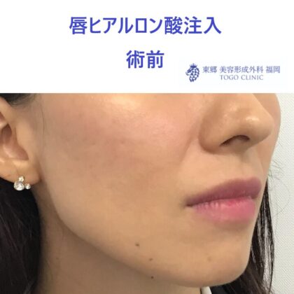 20レティシアミヤノハラ唇HA術前斜め