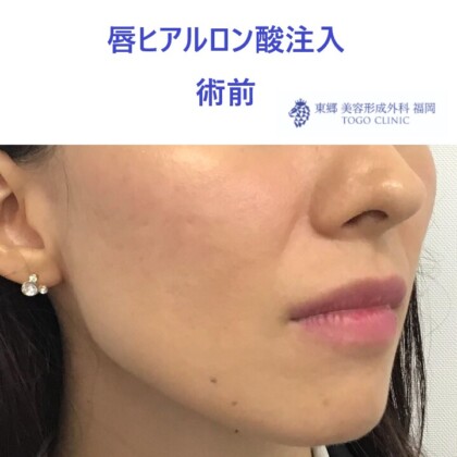 20レティシアミヤノハラ唇HA術前斜め