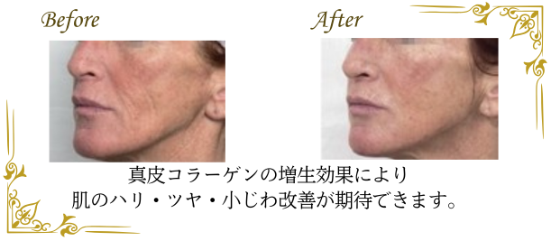 マッサージピールによる、小じわの改善