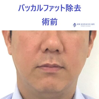 51ヒロセカツシ　バッカルファット　術前正面_R