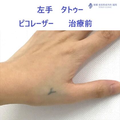 71ヒラガリサ　タトゥーピコレーザー術前_R