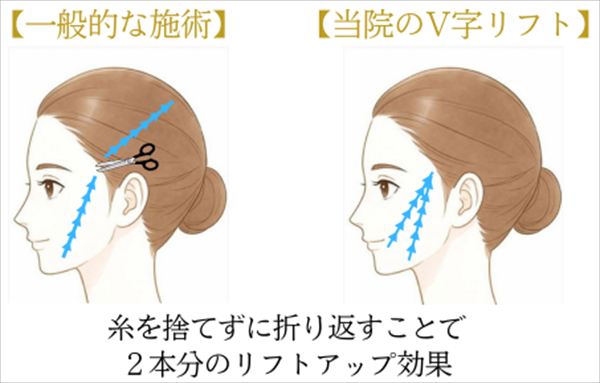 当院オリジナルの糸リフト