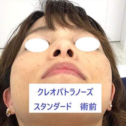 192フルヤタカコKPノーズ術前下_R