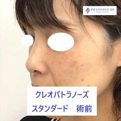 192フルヤタカコＫＰノーズ術前ななめ_R