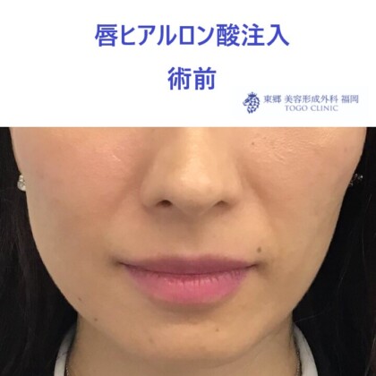 20レティシアミヤノハラ唇HA術前