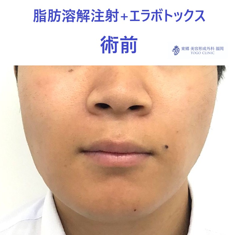 24コガヨシタカ　エラボトＢＮＬＳ術前_R