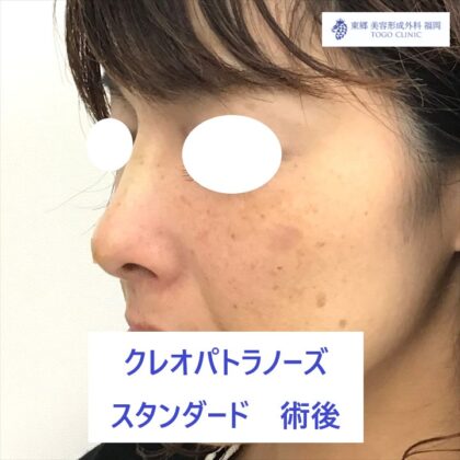 192フルヤタカコＫＰノーズ術後ななめ_R