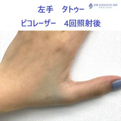 71ヒラガリサ　タトゥーピコレーザー術後_R