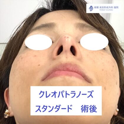 192フルヤタカコKPノーズ術後下_R