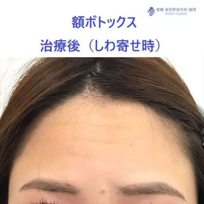 141シミズユミカ額ボト　術後しわよせ_R