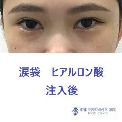 1817ハマチフタバ涙袋HA術後