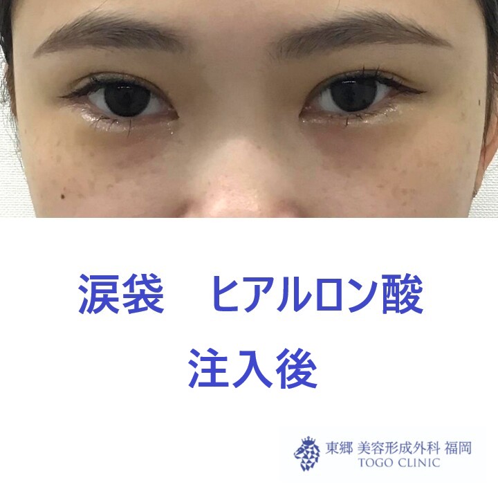 1817ハマチフタバ涙袋HA術後
