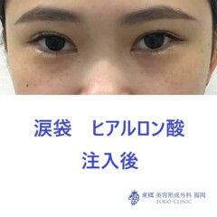 1817ハマチフタバ涙袋HA術後