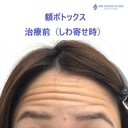 141シミズユミカ額ボト　術前しわよせ_R
