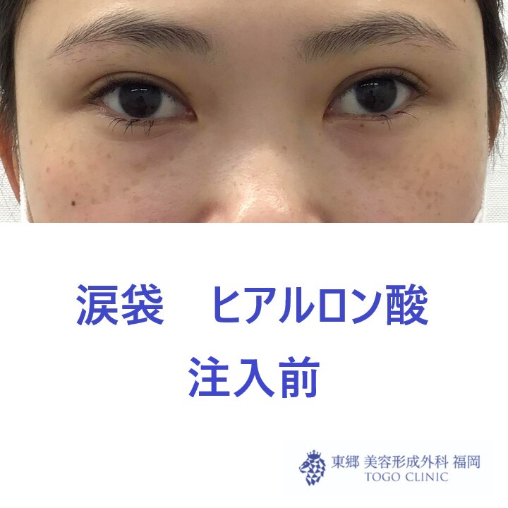 1817ハマチフタバ涙袋HA術前