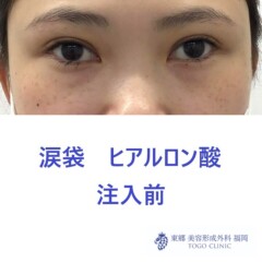 1817ハマチフタバ涙袋HA術前