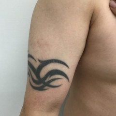 タトゥー・刺青　ピコレーザー治療