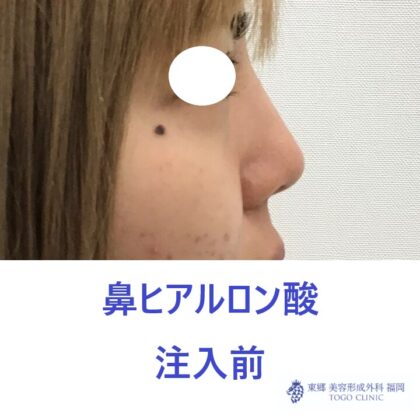 979ナカニシケイナ鼻HA術前横