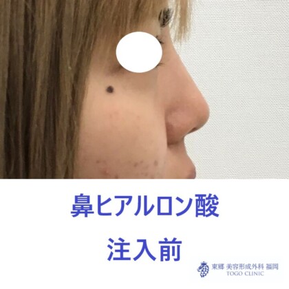 979ナカニシケイナ鼻HA術前横