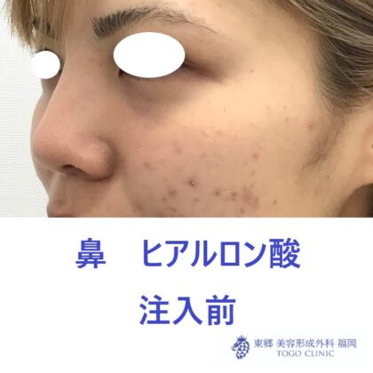 979ナカニシケイナ鼻HA術前斜め