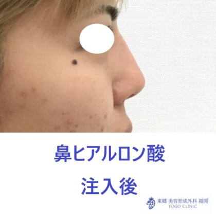 979ナカニシケイナ鼻HA術後横
