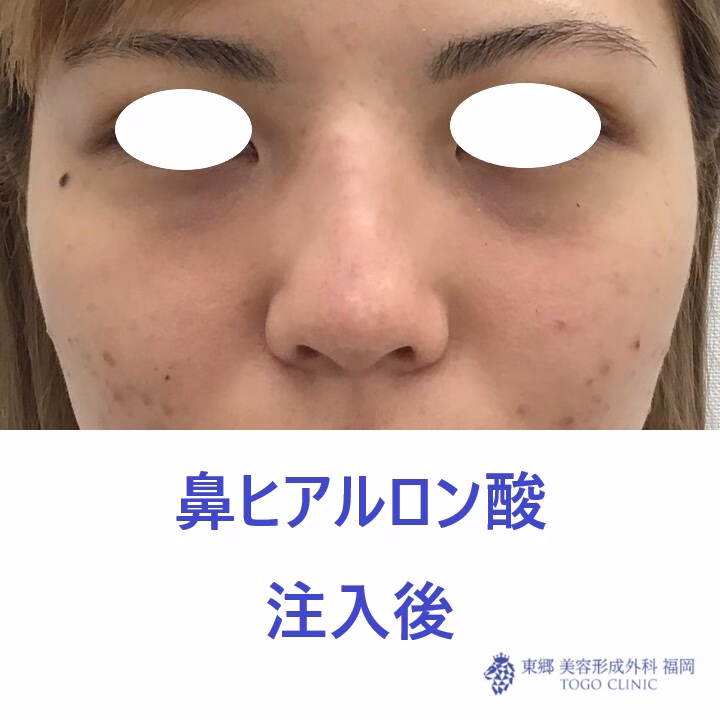979ナカニシケイナ鼻HA術後正面