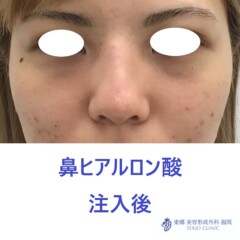979ナカニシケイナ鼻HA術後正面