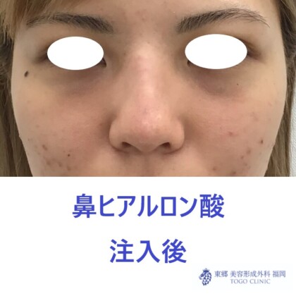 979ナカニシケイナ鼻HA術後正面