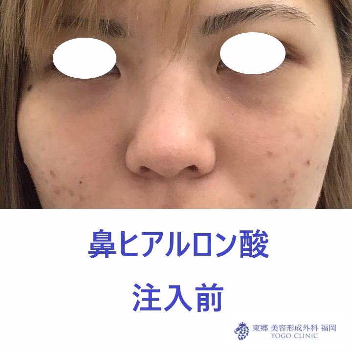 979ナカニシケイナ鼻HA術前正面