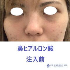 979ナカニシケイナ鼻HA術前正面
