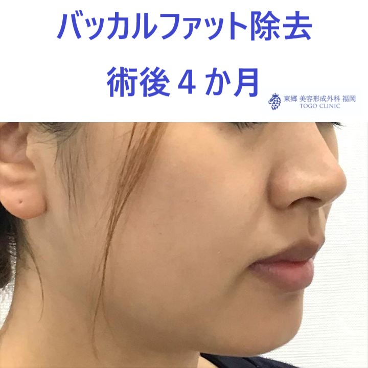 33ウチダマイ　バッカルファット術後ななめ_R