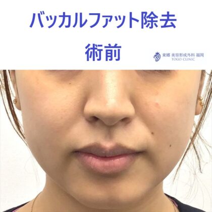 33ウチダマイ　バッカルファット術前正面_R