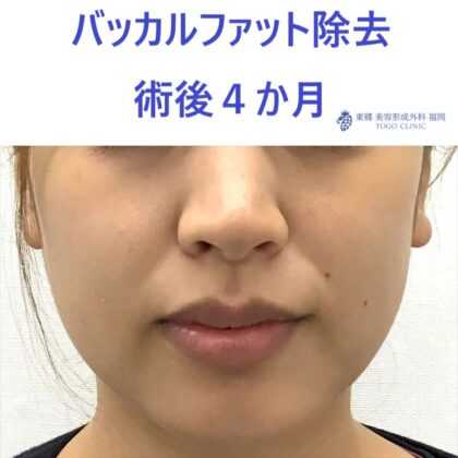 33ウチダマイ　バッカルファット術後正面_R