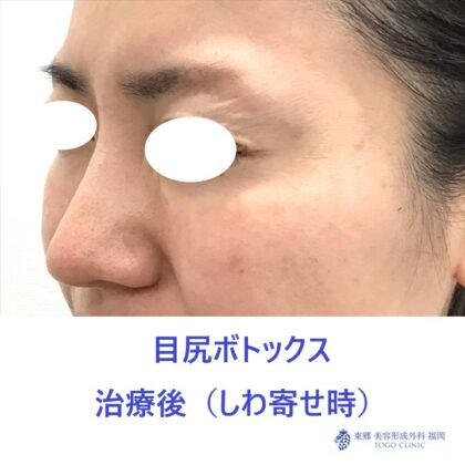429ハラミズキ様　目尻ボトックス　術後しわよせ斜め_R