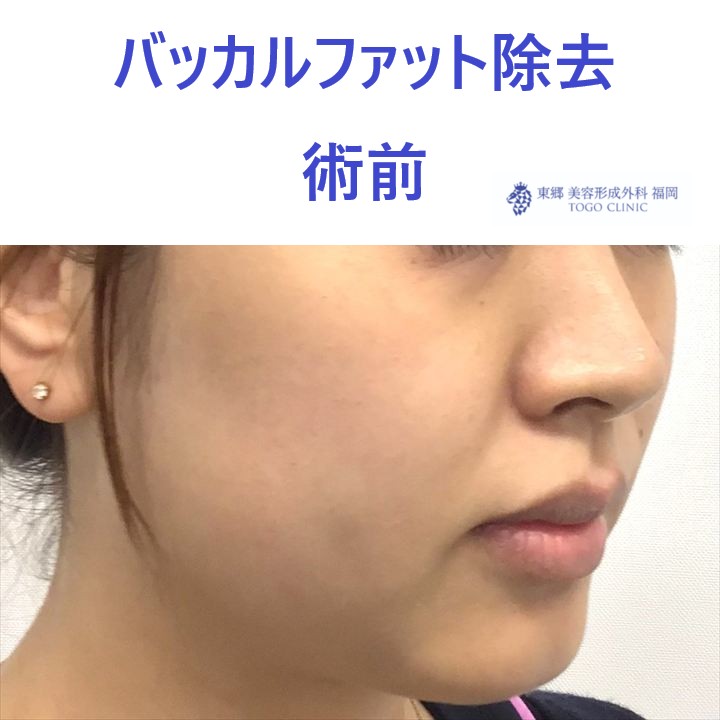33ウチダマイ　バッカルファット術前ななめ_R