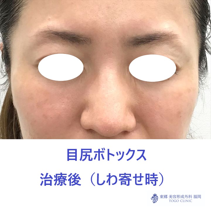 429ハラミズキ様　目尻ボトックス　術後しわよせ正面_R