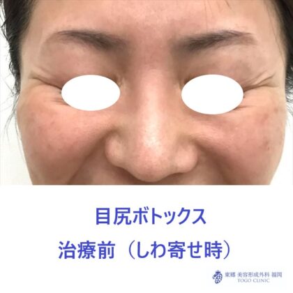 429ハラミズキ様　目尻ボトックス　術前しわよせ正面_R