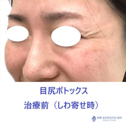 429ハラミズキ様　目尻ボトックス　術前しわよせ斜め_R