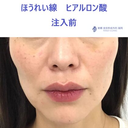 46タケウチカオリ　ほうれい線ＨＡ術前_R