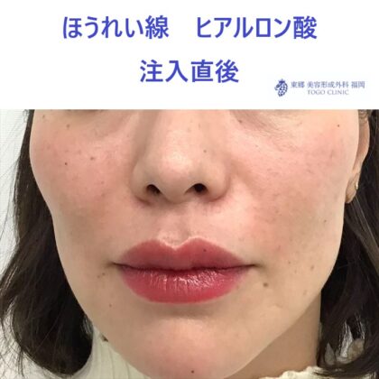 46タケウチカオリ　ほうれい線ＨＡ術後_R