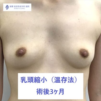 2216フジイユイ乳頭縮小　術後正面_R