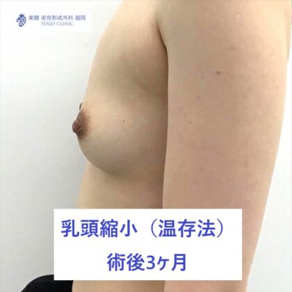 2216フジイユイ乳頭縮小　術後よこ_R
