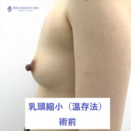 2216フジイユイ乳頭縮小　術前よこ_R