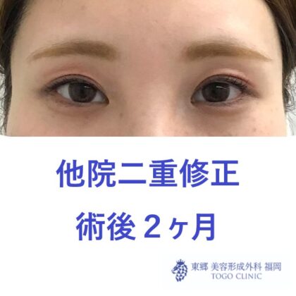 34モリアヤメ　二重修正術後正面①_R