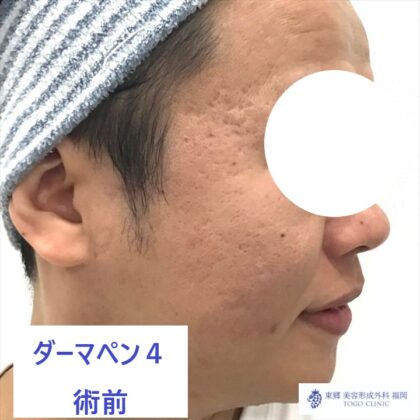 1543クリヤマシンヤ　ダーマペン術前横_R