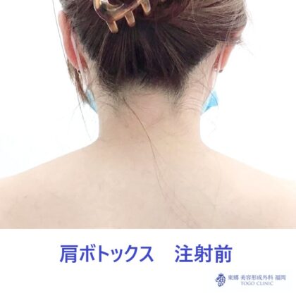 34 モリアヤメ　肩ボト　術前
