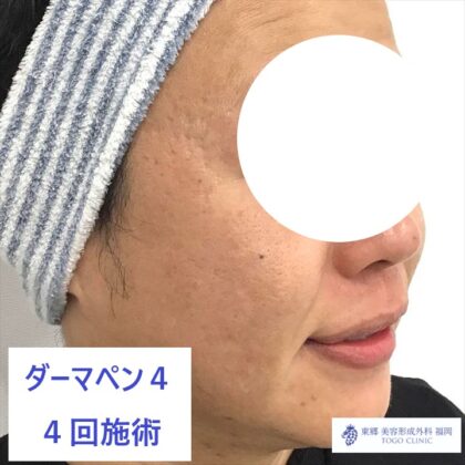 1543クリヤマシンヤ　ダーマペン術後横_R